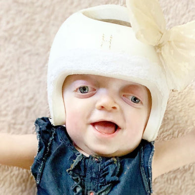 Halle - Halle Beams Happiness At One Years Old After Overcoming Skull Surgery / Pfeiffer Syndrome
